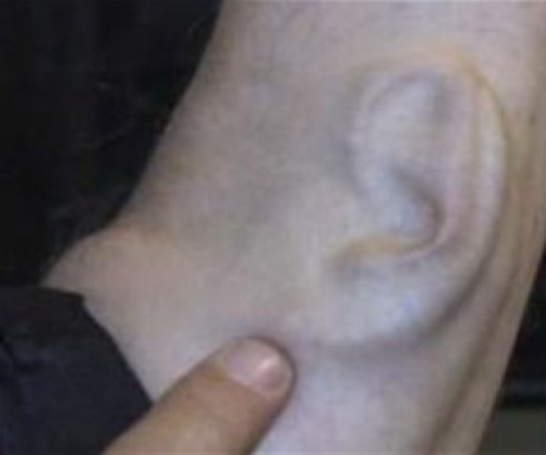Украинские ученые вырастили ухо на руке пациента