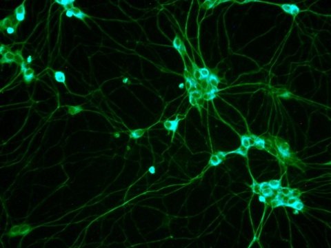 Стволовые клетки костного мозга, могут стать решением проблемы инфарктов