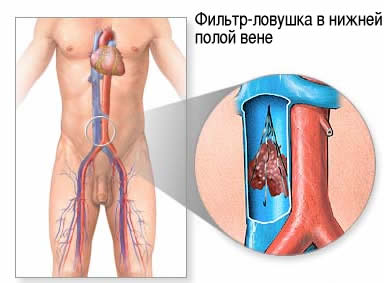 Съемные кава-фильтры для предупреждения тромбоэмболии легочной артерии