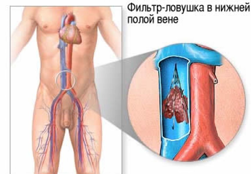 Съемные кава-фильтры для предупреждения тромбоэмболии легочной артерии