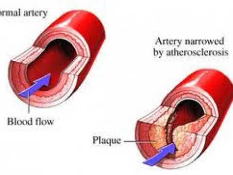 Найден способ лечения атеросклероза
