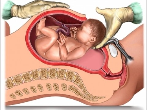 Естественные роды гораздо полезнее для детей, чем кесарево сечение