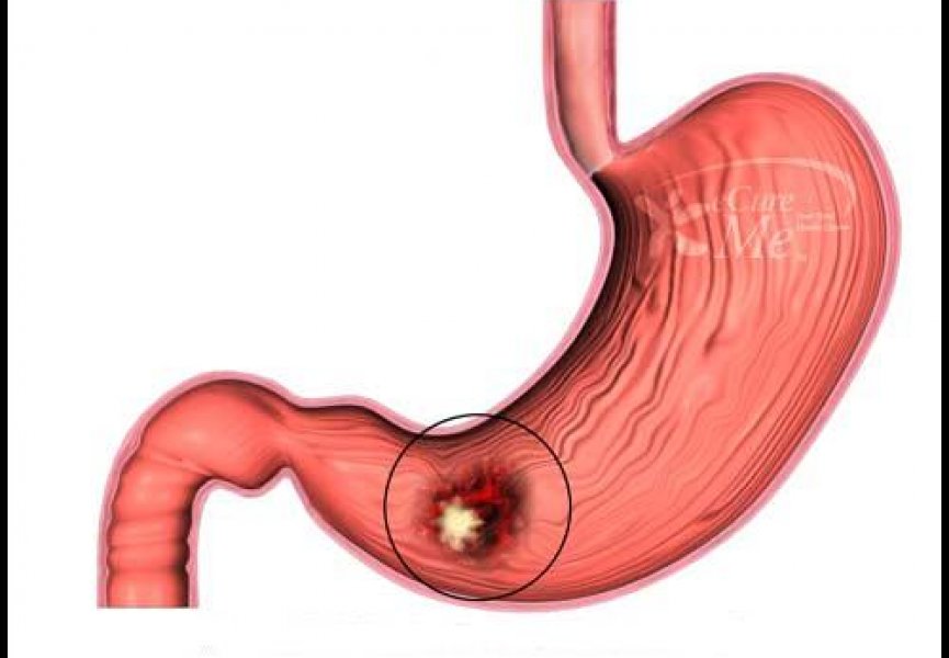 Ученые описали механизм заболевания раком желудка