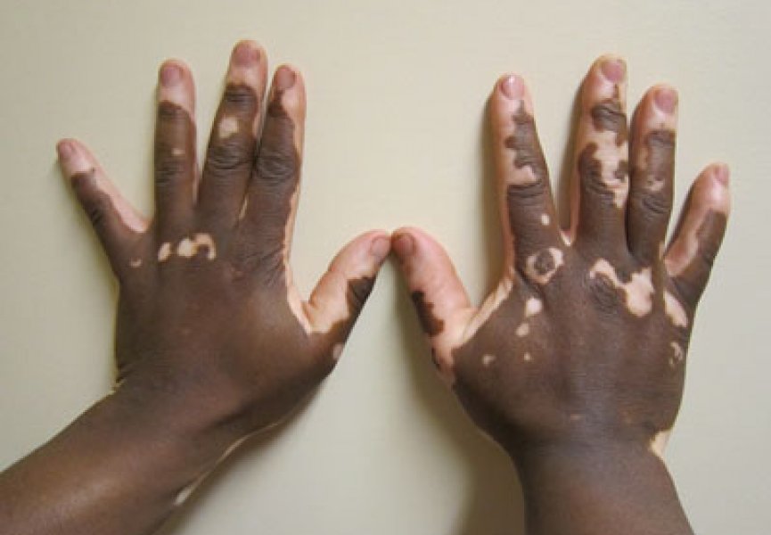 Загадочная генетика «загадочной болезни кожи» — витилиго