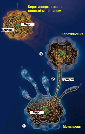 В норме меланин, синтезируемый в меланоцитах (1), по отросткам-дендритам (2) попадает в кератиноциты (3) и накапливается в них, вызывая потемнение кожи (загар). При возникновении меланомы перерожденные меланоциты разносятся кровью по всему организму. Благодаря наличию в них гранул меланина и стал возможен фотоакустический метод их детектирования (изображение с сайта www.scf-online.com)