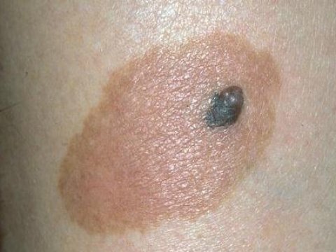Ученым удалось раскрыть секрет влияния ультрафиолета на кожу человека