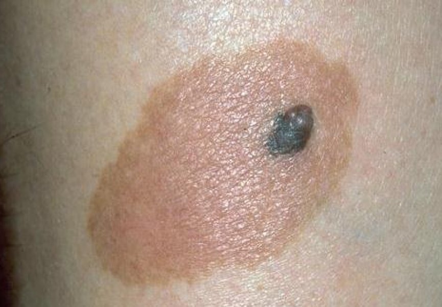 Ученым удалось раскрыть секрет влияния ультрафиолета на кожу человека