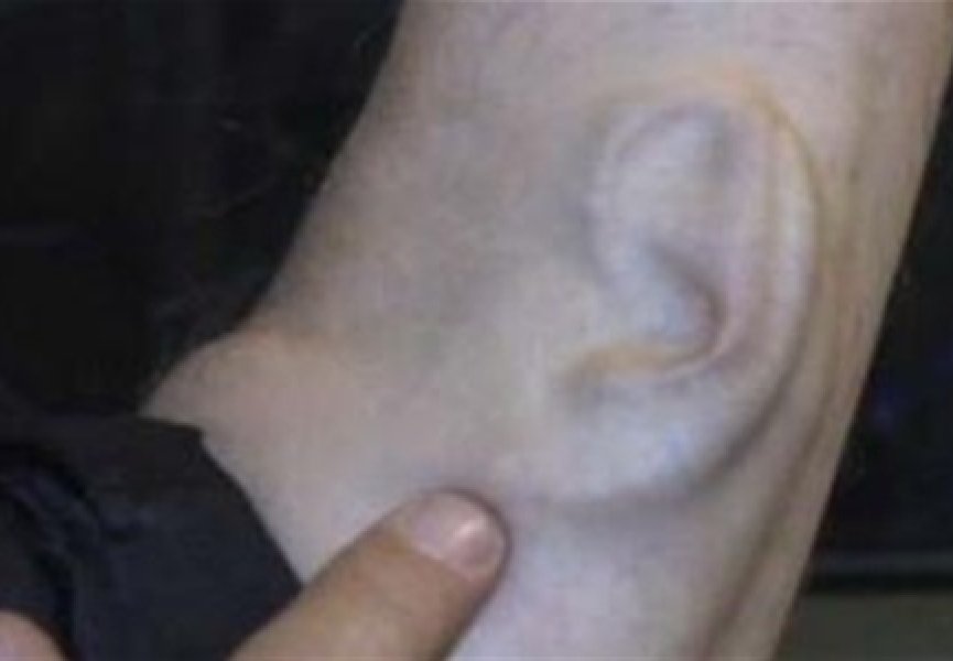Украинские ученые вырастили ухо на руке пациента