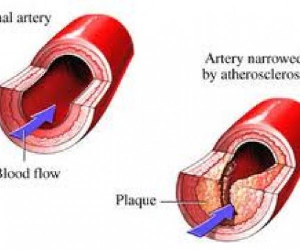 Найден способ лечения атеросклероза