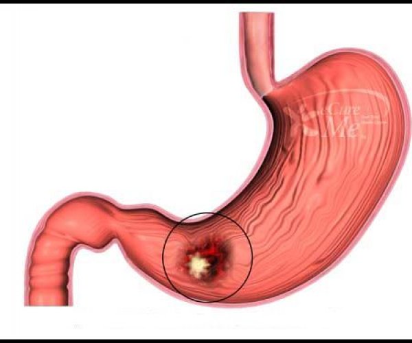 Ученые описали механизм заболевания раком желудка